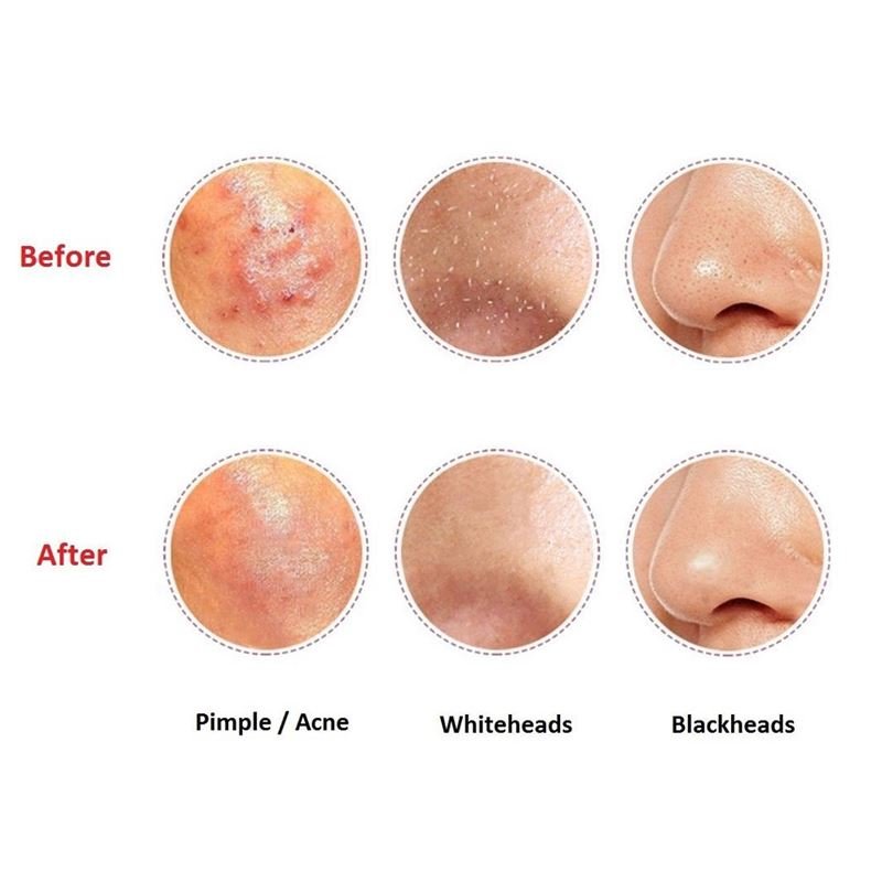 Blackhead Tweezer - Blackhead Remover Tweezers - | Fashiongirl